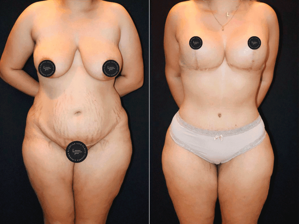 Antes-e-Depois-Lipo