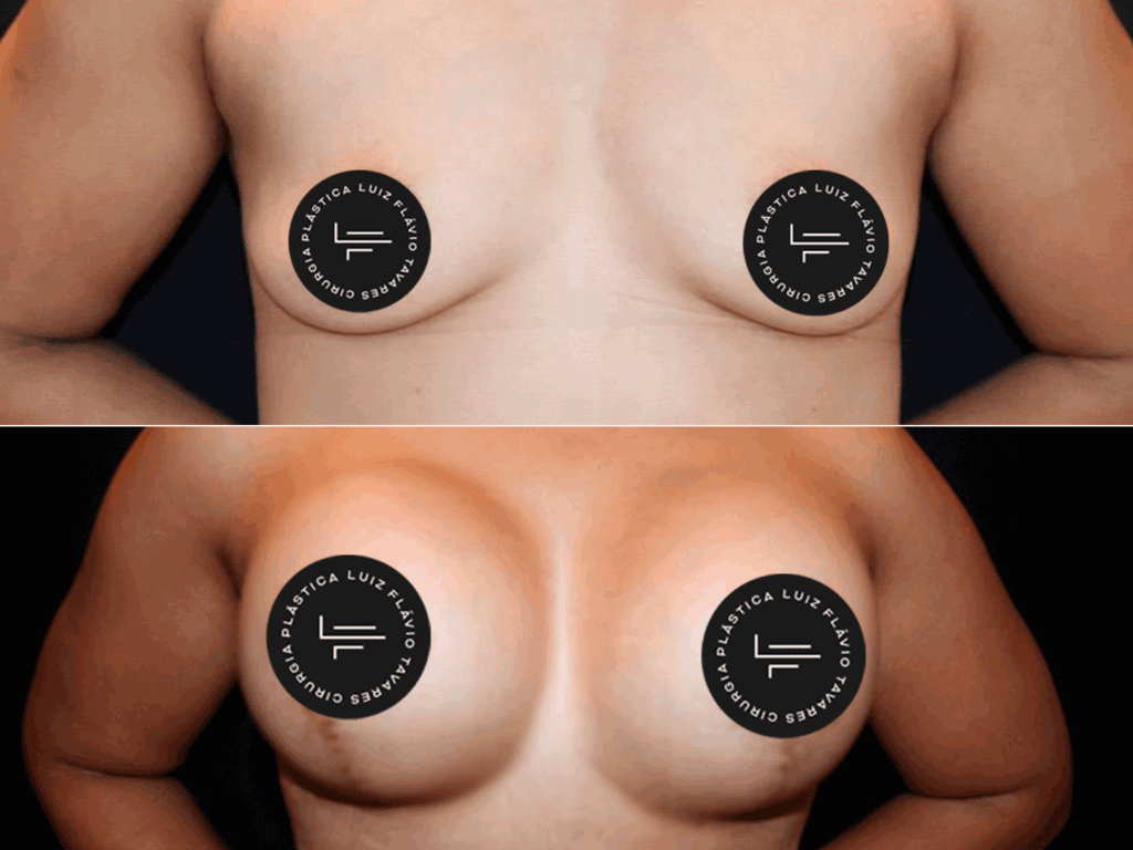 Antes-e-Depois-Mamo2