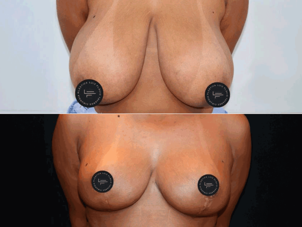 Antes-e-Depois-Masto