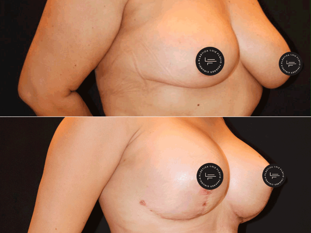 Antes-e-Depois-MastoL